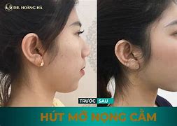 Dưới Cằm Có Nọng